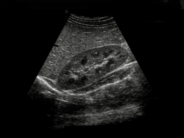 ultrasound of kidney